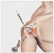 Arthroscopic Rotator Cuff Repair